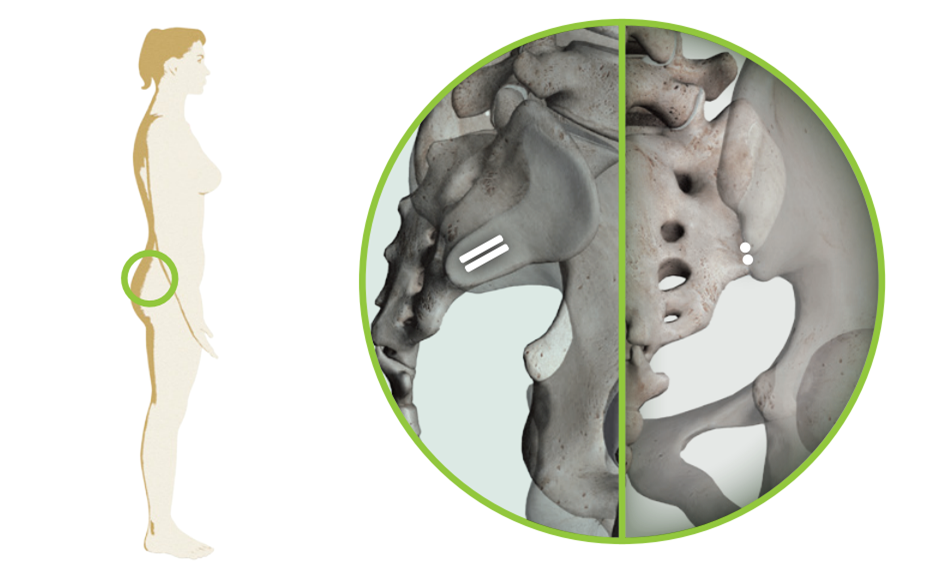 Lower back incision